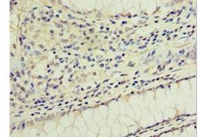 Immunohistochemistry of paraffin-embedded human colon cancer using ABIN7154311 at dilution of 1:100 (GS28 anticorps  (AA 1-115))