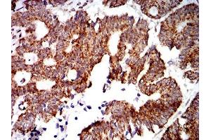 Immunohistochemical analysis of paraffin-embedded rectum cancer tissues using PTPN14 mouse mAb with DAB staining.