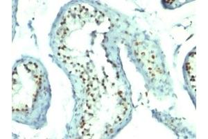 Formalin-fixed, paraffin-embedded human testicular carcinoma stained with Nucleolin antibody.