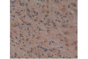 Detection of NOG in Human Glioma Tissue using Monoclonal Antibody to Noggin (NOG) (NOG anticorps  (AA 28-232))