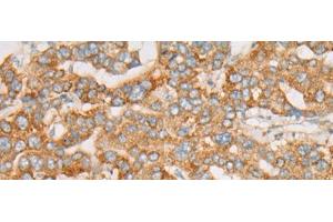 Immunohistochemistry of paraffin-embedded Human liver cancer tissue using ATXN7 Polyclonal Antibody at dilution of 1:60(x200) (ATXN7 anticorps)