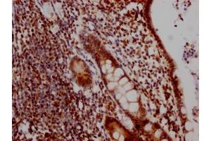 IHC image of ABIN7127450 diluted at 1:100 and staining in paraffin-embedded human colon cancer performed on a Leica BondTM system. (Recombinant DDX5 anticorps)