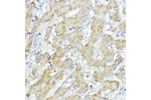 Immunohistochemistry of paraffin-embedded human liver cancer using SOCS6 antibody (ABIN6128785, ABIN6148273, ABIN6148274 and ABIN6225294) at dilution of 1:100 (40x lens).