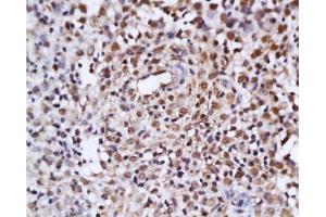 Formalin-fixed and paraffin embedded human endometrium tissue labeled with Anti-ER-alpha/beta Polyclonal Antibody, Unconjugated  at 1:200 followed by conjugation to the secondary antibody and DAB staining (Estrogen Receptor alpha + beta (AA 201-300) anticorps)