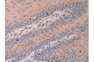 Detection of ATF4 in Human Stomach cancer Tissue using Polyclonal Antibody to Activating Transcription Factor 4 (ATF4)