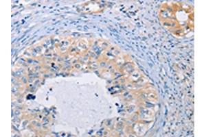The image on the left is immunohistochemistry of paraffin-embedded Human cervical cancer tissue using ABIN7128287(AGBL5 Antibody) at dilution 1/30, on the right is treated with fusion protein.
