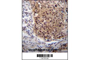 EXTL3 Antibody immunohistochemistry analysis in formalin fixed and paraffin embedded human esophageal carcinoma followed by peroxidase conjugation of the secondary antibody and DAB staining.