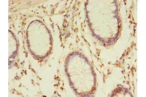 Immunohistochemistry of paraffin-embedded human colon cancer using ABIN7172979 at dilution of 1:100 (TMED3 anticorps  (AA 24-180))