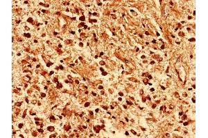Immunohistochemistry analysis of human glioma using ABIN7163605 at dilution of 1:100 (PAFAH1B2 anticorps  (AA 2-229))