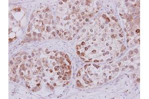 IHC-P Image STMN2 antibody detects STMN2 protein at cytoplasm on human liver carcinoma by immunohistochemical analysis. (STMN2 anticorps  (N-Term))