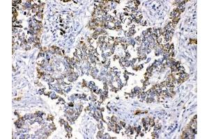 IHC testing of FFEP human lung cancer tissue with Periplakin antibody at 1ug/ml.