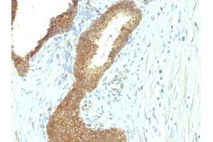 Formalin-fixed, paraffin-embedded human Colon Carcinoma stained with Alkaline Phosphatase Mouse Monoclonal Antibody (ALPL/597). (ALPL anticorps)