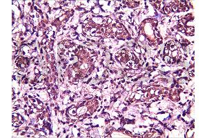 Formalin-fixed and paraffin embedded human breast carcinoma labeled with Anti-BRMS-1 Polyclonal Antibody, Unconjugated (ABIN730933) at 1:200, followed by conjugation to the secondary antibody and DAB staining (BRMS1L anticorps  (AA 151-246))