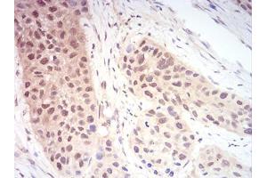 Immunohistochemical analysis of paraffin-embedded esophageal cancer tissues using RAN mouse mAb with DAB staining. (RAN anticorps  (AA 1-216))