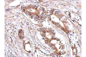 IHC-P Image Immunohistochemical analysis of paraffin-embedded human gastric cancer, using LHR, antibody at 1:500 dilution. (LHCGR anticorps  (C-Term))
