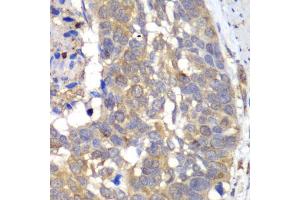 Immunohistochemistry of paraffin-embedded human esophageal cancer using H antibody (ABIN6129787, ABIN6141601, ABIN6141603 and ABIN6216048) at dilution of 1:100 (40x lens). (HAPLN1 anticorps  (AA 165-354))