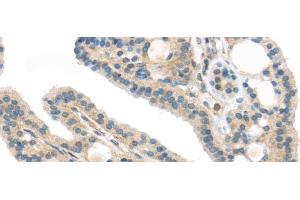 Immunohistochemistry of paraffin-embedded Human thyroid cancer using VPS26A Polyclonal Antibody at dilution of 1/40
