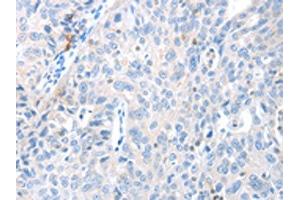 The image on the left is immunohistochemistry of paraffin-embedded Human ovarian cancer tissue using ABIN7130139(MAGEB4 Antibody) at dilution 1/40, on the right is treated with fusion protein. (MAGEB4 anticorps)