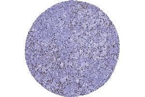 Hodgkins lymphoma containing numerous reactive CTLA 4 positive lymphocytes