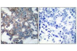 Immunohistochemical analysis of paraffin-embedded human breast carcinoma tissue using p70 S6 Kinase(Phospho-Ser424) Antibody(left) or the same antibody preincubated with blocking peptide(right).