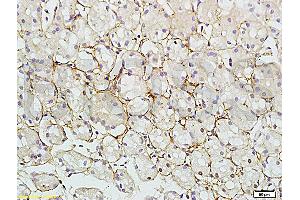Formalin-fixed and paraffin embedded human colon carcinoma tissue labeled with Rabbit Anti-RAB7 Polyclonal Antibody (ABIN720191) at 1:200 followed by conjugation to the secondary antibody and DAB staining. (RAB7A anticorps  (AA 101-207))