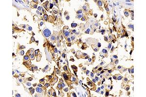 Immunohistochemistry analysis of paraffin-embedded human lung cancer using AQP1 Polyclonal Antibody at dilution of 1:400. (Aquaporin 1 anticorps)