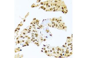 Immunohistochemistry of paraffin-embedded human lung cancer using SMEK1 antibody (ABIN5974870) at dilution of 1/100 (40x lens). (SMEK1 anticorps)