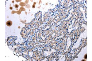 Immunohistochemistry of Human stomach cancer using UTS2 Polyclonal Antibody at dilution of 1:100 (Urotensin 2 anticorps)