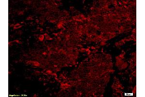 Formalin-fixed and paraffin embedded human lung carcinoma labeled with Anti-phospho-NFKBIA(Ser32/36) Polyclonal Antibody, PE Conjugated (ABIN741360) at 1:200