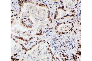 IHC-P: Lamin A/C antibody testing of human lung cancer tissue