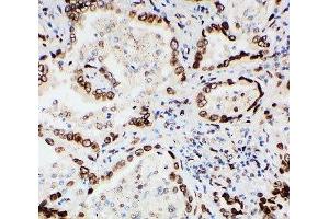 IHC-P: Lamin A/C antibody testing of human lung cancer tissue (Lamin A/C anticorps  (AA 455-469))
