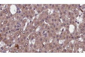ABIN6277556 at 1/100 staining Human liver cancer tissue by IHC-P. (PVRL2 anticorps  (Internal Region))