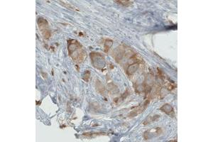 Immunohistochemical staining (Formalin-fixed paraffin-embedded sections) of human breast cancer with PHGDH monoclonal antibody, clone CL0555  shows moderate cytoplasmic immunoreactivity in tumor cells. (PHGDH anticorps)