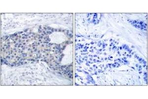 Immunohistochemistry analysis of paraffin-embedded human breast carcinoma, using ZAP-70 (Phospho-Tyr493) Antibody. (ZAP70 anticorps  (pTyr493))