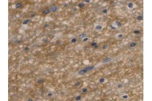 Detection of AQP4 in Human Glioma Tissue using Monoclonal Antibody to Aquaporin 4 (AQP4)