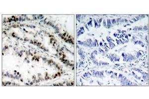 Immunohistochemical analysis of paraffin-embedded human lung carcinoma tissue using SMC1 (phospho-Ser957) antibody (E011198). (SMC1A anticorps  (pSer957))
