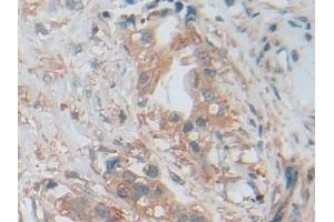 Detection of PKBg in Human Pancreatic cancer Tissue using Polyclonal Antibody to Protein Kinase B Gamma (PKBg)