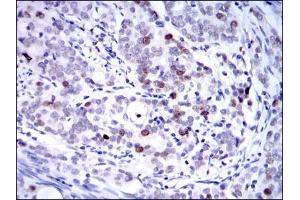 Immunohistochemical analysis of paraffin-embedded cervical cancer tissues using KID mouse mAb with DAB staining. (KIF22 anticorps)