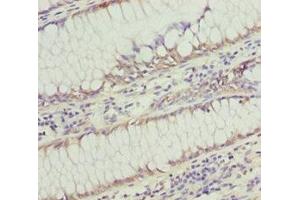 Immunohistochemistry of paraffin-embedded human colon cancer using ABIN7171004 at dilution of 1:100 (SOCS4 anticorps  (AA 1-270))