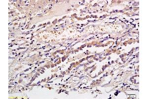 Formalin-fixed and paraffin embedded human gastric cancer labeled with Anti CD1a/Cortical thymocyte antigen CD1A Polyclonal Antibody, Unconjugated  at 1:300 followed by conjugation to the secondary antibody and DAB staining