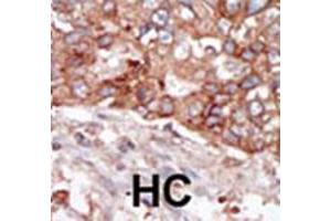 Formalin-fixed and paraffin-embedded human hepatocellular carcinoma tissue reacted with BLK polyclonal antibody  , which was peroxidase-conjugated to the secondary antibody, followed by AEC staining. (BLK anticorps  (N-Term))