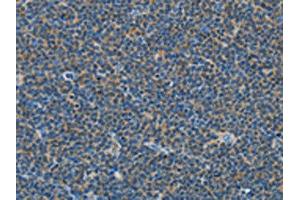 The image on the left is immunohistochemistry of paraffin-embedded Human lymphoma tissue using ABIN7129020(COX7B2 Antibody) at dilution 1/15, on the right is treated with fusion protein. (COX7B2 anticorps)