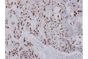 IHC-P Image Immunohistochemical analysis of paraffin-embedded FaDu xenograft, using NULP1, antibody at 1:100 dilution. (TCF25 anticorps  (C-Term))