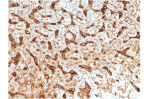 Formalin-fixed, paraffin-embedded human Hepatocellular Carcinoma stained with Albumin Mouse Monoclonal Antibody (ALB/2144). (Albumin anticorps)