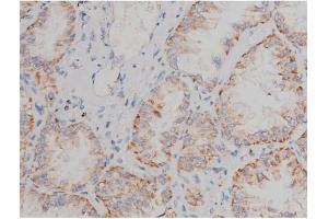 ABIN6267496 at 1/200 staining Human lung cancer tissue sections by IHC-P. (SNCA anticorps  (pSer129))