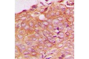 Immunohistochemical analysis of SPTBN1 staining in human breast cancer formalin fixed paraffin embedded tissue section. (SPTBN1 anticorps)