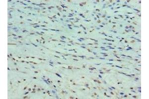 Immunohistochemistry of paraffin-embedded human breast cancer using ABIN7165931 at dilution of 1:100