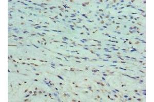 Immunohistochemistry of paraffin-embedded human breast cancer using ABIN7165931 at dilution of 1:100 (DARPP32 anticorps  (Regulatory Subunit 1B))