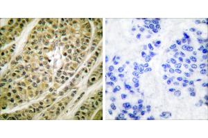 Peptide - +Immunohistochemical analysis of paraffin-embedded human breast carcinoma tissue using HDAC5 antibody (#C0225). (HDAC5 anticorps)