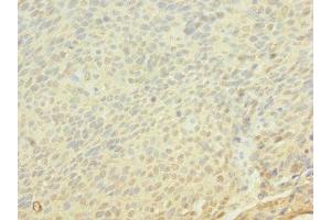 Immunohistochemistry of paraffin-embedded human cervical cancer using ABIN7152849 at dilution of 1:100 (FRS3 anticorps  (AA 101-400))